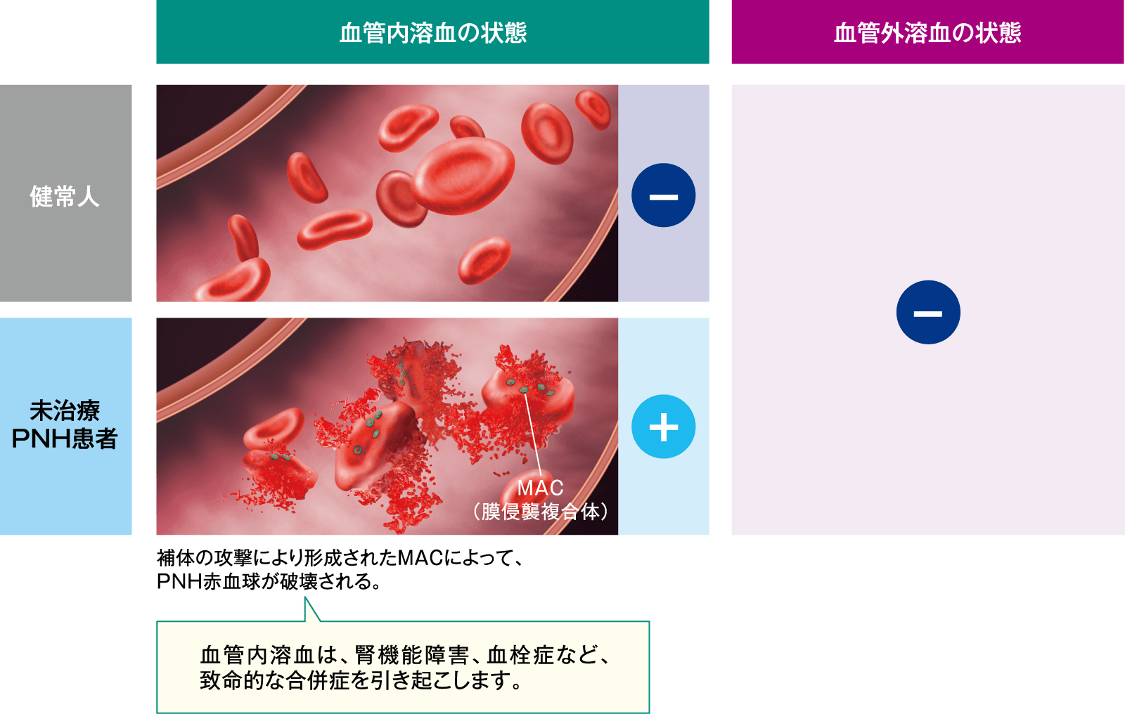 PNHの治療戦略として最も重要なのは血管内溶血のコントロールです。