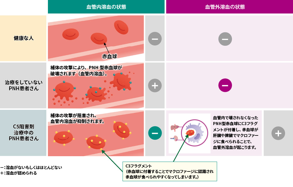 PNHにおける溶血